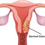 Early Marriage linked to Cervical Cancer