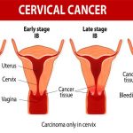 Community perceptions on cervical cancer and cervical cancer screening