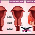 Cervical Cancer in Bangladesh: Community Perceptions of Cervical Cancer and Cervical Cancer Screening